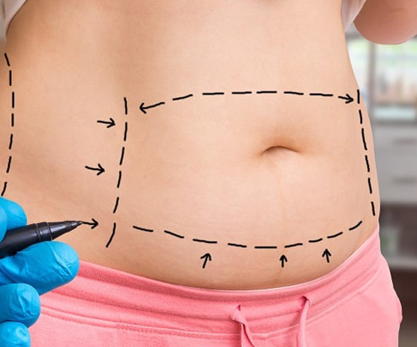 Tummy Tuck in ludhiana, punjab