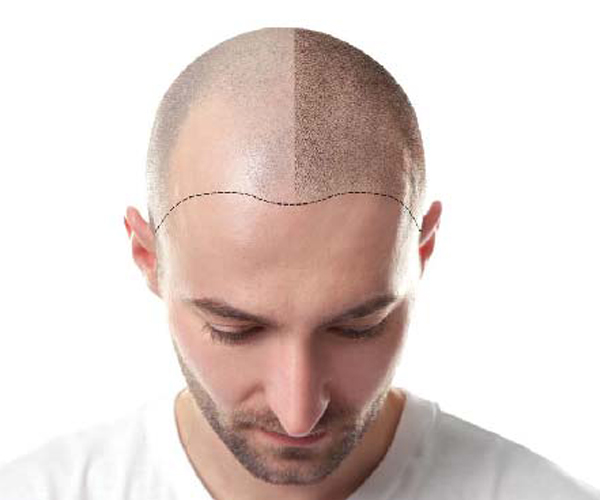 Hair Transplant in ludhiana, punjab