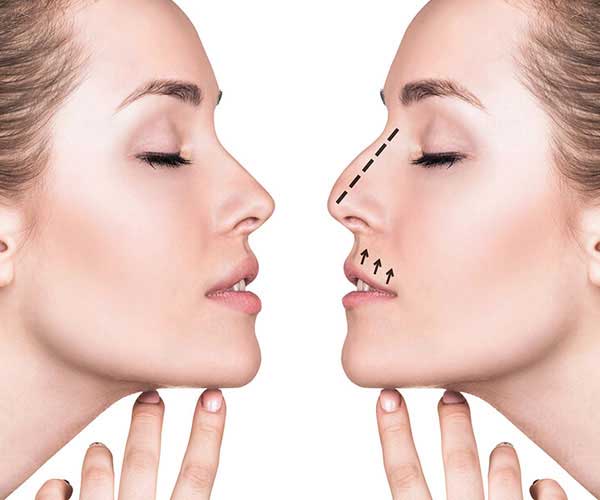 Rhinoplasty in ludhiana, punjab